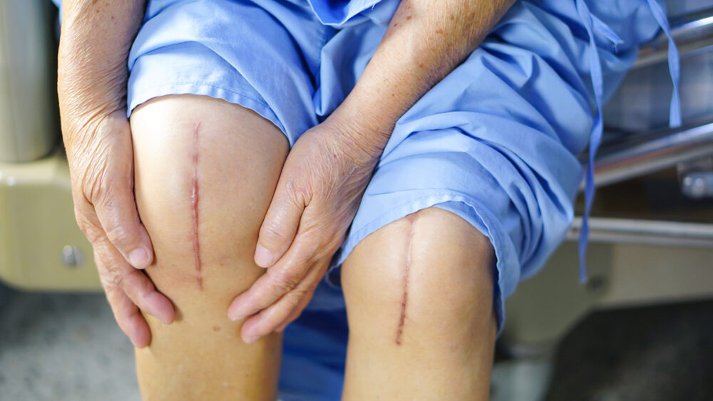 Exactech Knee Replacement Lawsuit Attorney in Florida